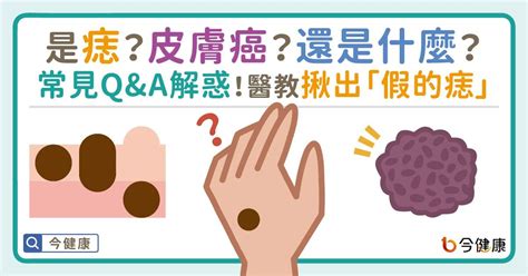 痣為什麼會凸起來|是痣or皮膚癌？醫「1張圖秒對照」 長這2部位最危險